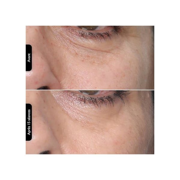 SILK'N Anti-rynkapparat FaceTite Multiplatform FTMP1PE1001
