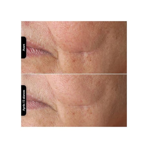 SILK'N Anti-rynkapparat FaceTite Multiplatform FTMP1PE1001