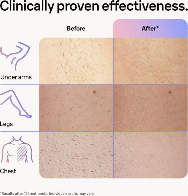 Braun Smart IPL Skin iExpert PL7253 IPL-enhed