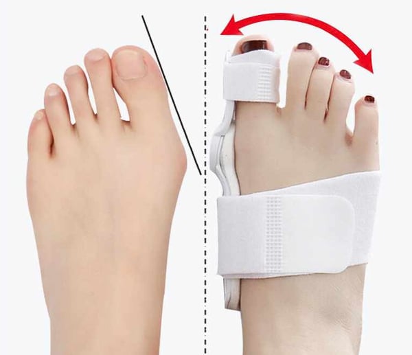 Hallux Valgus - Kolmivärinen tukituki - Kolmen värinen tukituki
