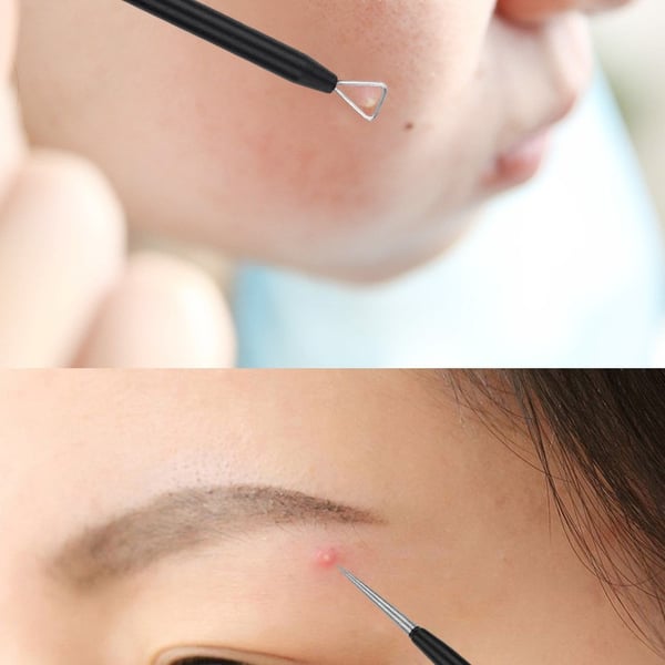 5 Pack Blackhead Remover Acne Needle Tools Kit Black