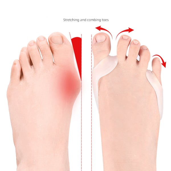 Tåstrekker, Hallux Valgus Korrigerer for Stortå