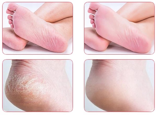 Fodfil med håndtag, hælfil, fræser, pedicuresæt, 3 spidser