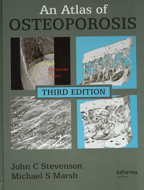 An Atlas of Osteoporosis
