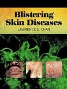 Blistering Skin Diseases