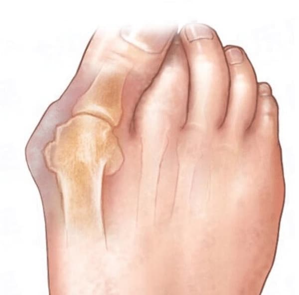 Skydd mot Hallux Valgus  (ORTISPHERE)