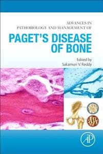 Advances in Pathobiology and Management of Paget’s Disease of Bone
