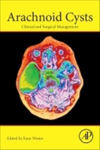 Arachnoid Cysts