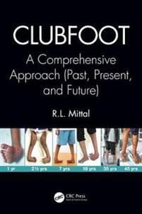 Clubfoot