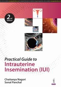 Practical Guide to Intrauterine Insemination (IUI)