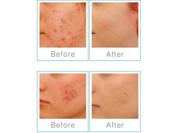 Rio Q-Acne Lite3 ansiktsrengöring