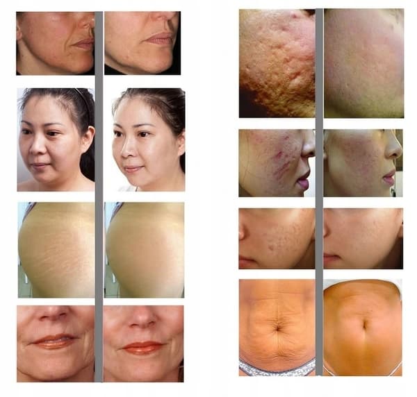 NÅLE MESOTERAPI DERMAROLLER 540 NÅLE ANSIGTSMASSAGEAPPARAT 0,5 mm