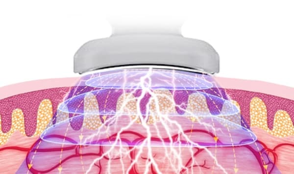 Nakkemassageapparat - Elektrisk pulsmassageapparat til nakken + fjernbetjening
