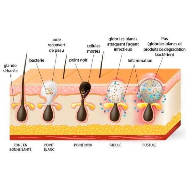 SHOP-STORY - Anti Acne Light Therapy riktad behandlingspenna