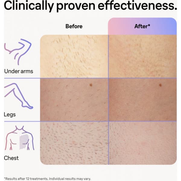 Braun Smart IPL Skin iExpert PL7253 IPL-enhed