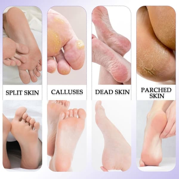 10 stk/sæt Fodpleje Pedicure Callus Dead Skin Remover Fodfil Fjernelse af hård hud
