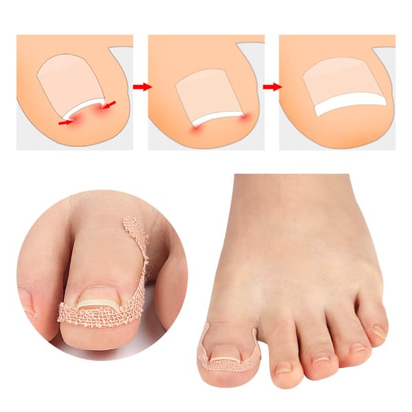 INF 10 kpl kynsien korjauslaastareita elastinen Mukava hengittävä beige  T003