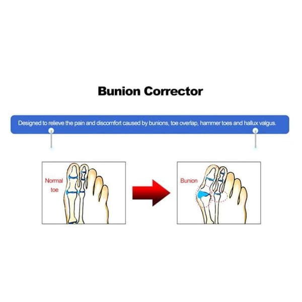 1 par stortåavskiljare Knivkorrektor Hallux Valgus Protector Hammer Plattång Plattång Relief From La-9