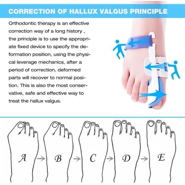 Kemei par korrigeringsdynor med skena för Hallux Valgus och bunion smärtlindring och korrigering för[~60]