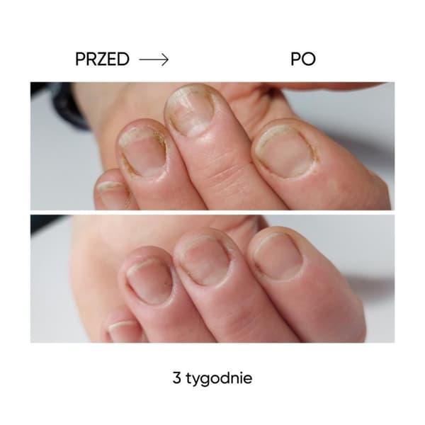 NAILSOFTHEDAY ONISTOP - uudistava öljy kynsille, joilla on kynsilevä, 15 ml