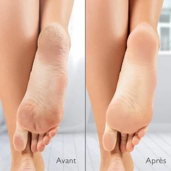 Electric Callus Remover Silk´n Vacupedi (5 antal)