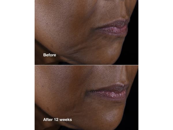 Clinique - Smart Clinical Repair- Lifting Face + Neck Cream 75 ml