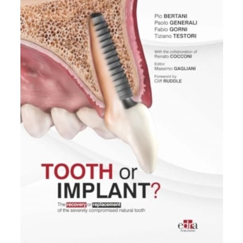 Tooth or Implant (inbunden, eng)
