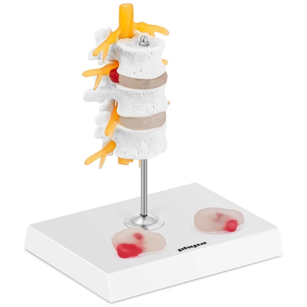 Physa Ländryggsbråck - Anatomisk modell