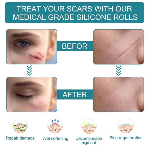 Silikonetape / Plastre til Ar - Treat Scars