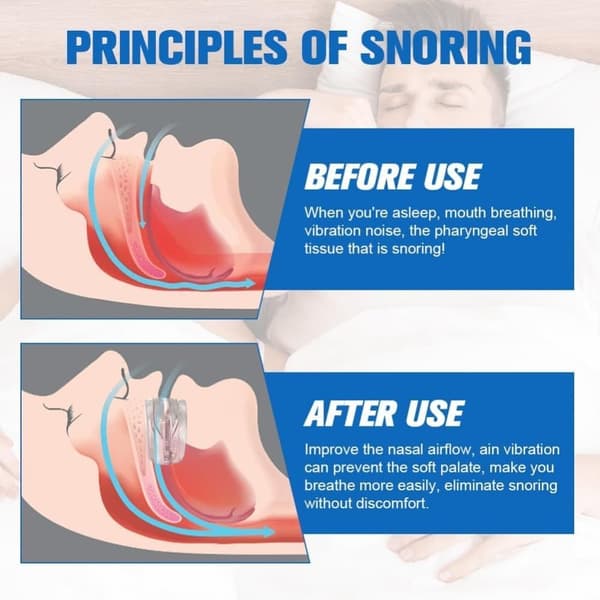 Auledio Anti-Snarkanordningar, Snarkningslösning Stoppa Snarkningsanordningar Snarkskydd, Förhindra Bruxism Och Snarkmunstycke