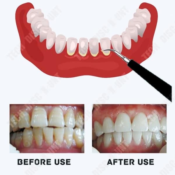 TD® Dental scaler Stone Remover Tandvårdsverktyg Elektriskt utbytbart rengöringshuvud Dental scaler