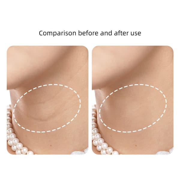 INF Halsrynkeplaster - Reduser fine linjer (5 plaster)