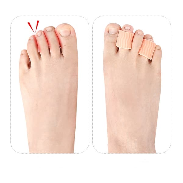 INF Vann Ripple Pinky Toe Caps, Anti-Wear Toe Caps, Blister Caps