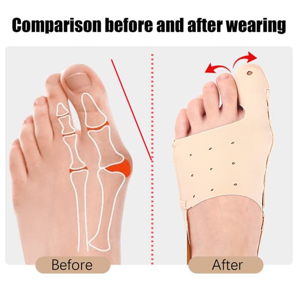 INF Bunion Corrector for Hallux Valgus, Justerbar Tårettetang 0
