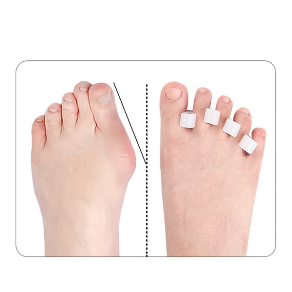 INF Silikon Tåskiller for Hallux Valgus - Hvit (En Størrelse)
